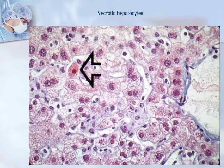 Necrotic hepatocytes 