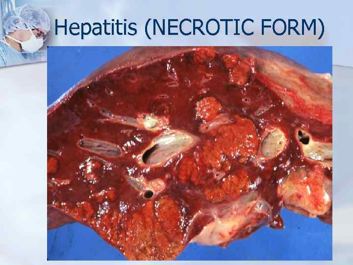 Hepatitis (NECROTIC FORM) 