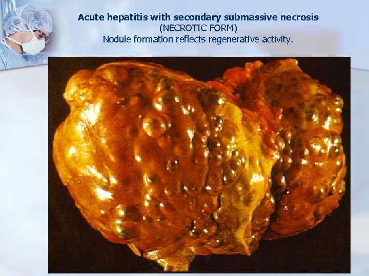 Acute hepatitis with secondary submassive necrosis (NECROTIC FORM) Nodule formation reflects regenerative activity. 