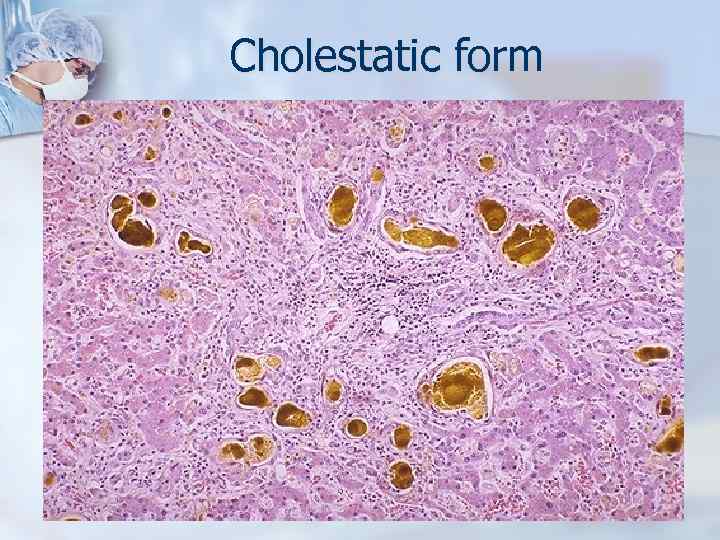 Cholestatic form 