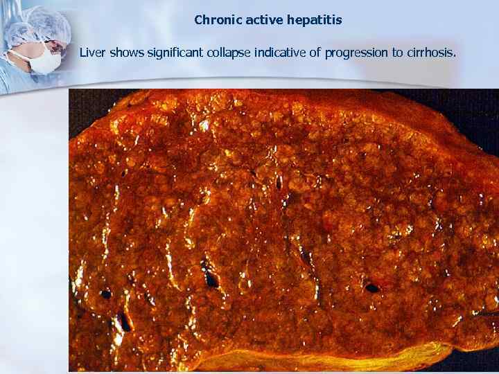 Chronic active hepatitis Liver shows significant collapse indicative of progression to cirrhosis. 