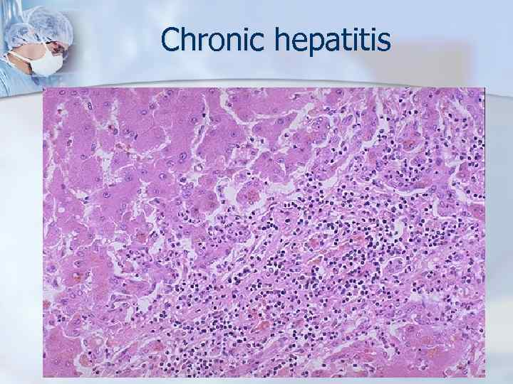 Chronic hepatitis 