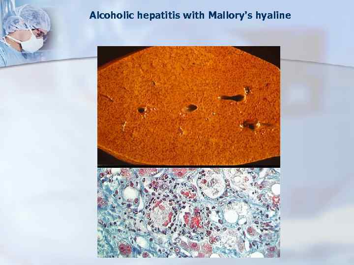 Alcoholic hepatitis with Mallory's hyaline 