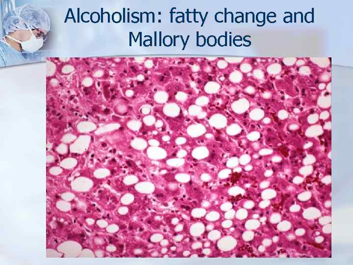 Alcoholism: fatty change and Mallory bodies 