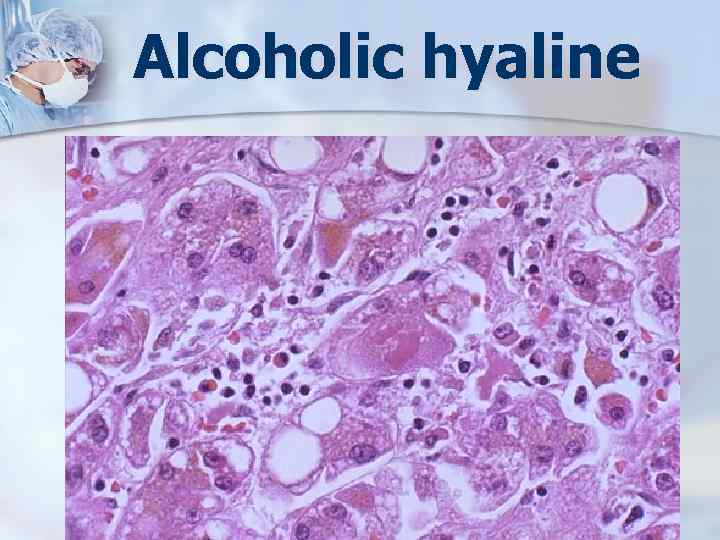 Alcoholic hyaline 