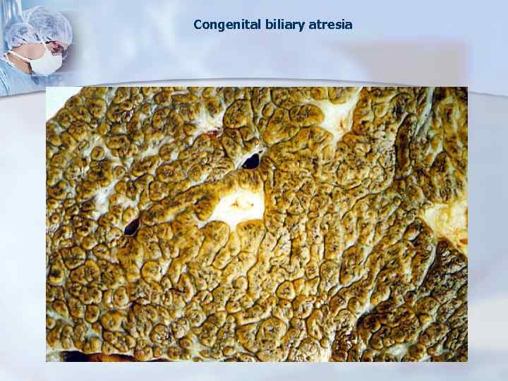 Congenital biliary atresia 
