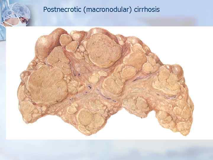 Postnecrotic (macronodular) cirrhosis 