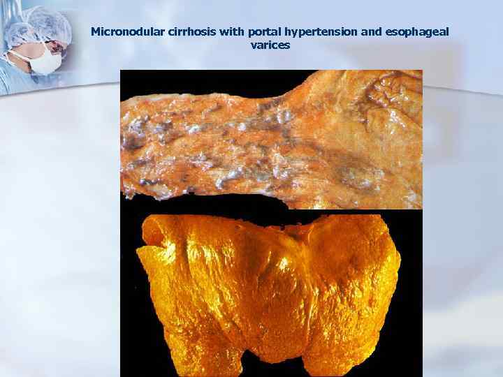 Micronodular cirrhosis with portal hypertension and esophageal varices 