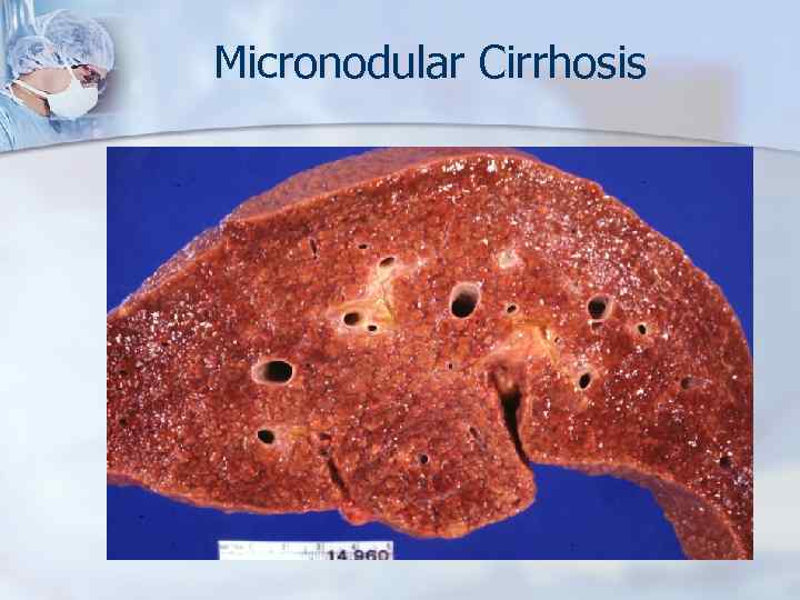Micronodular Cirrhosis 