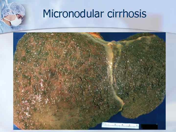 Micronodular cirrhosis 