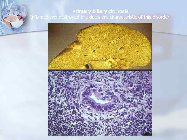 Primary biliary cirrhosis Inflamed and destroyed bile ducts are characteristic of this disorder. 