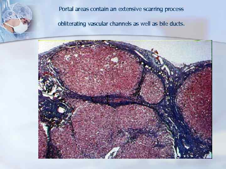 Portal areas contain an extensive scarring process obliterating vascular channels as well as bile