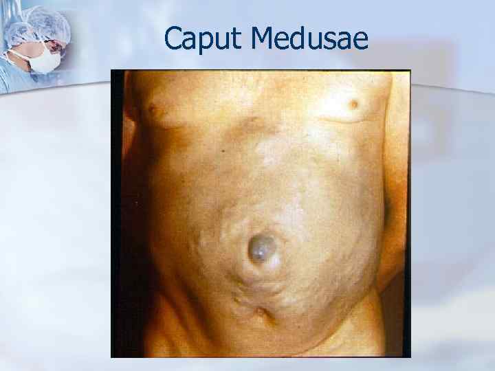 Caput Medusae 