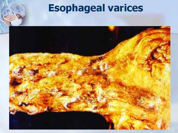 Esophageal varices n 