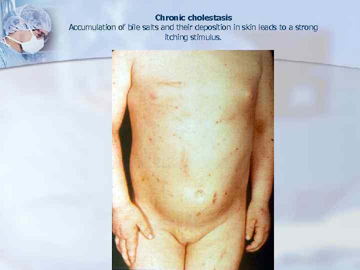 Chronic cholestasis Accumulation of bile salts and their deposition in skin leads to a