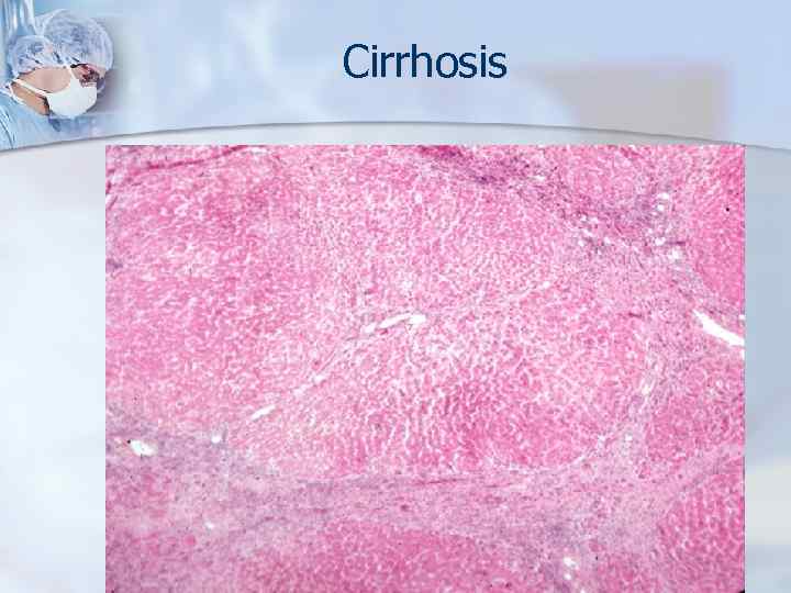 Cirrhosis 