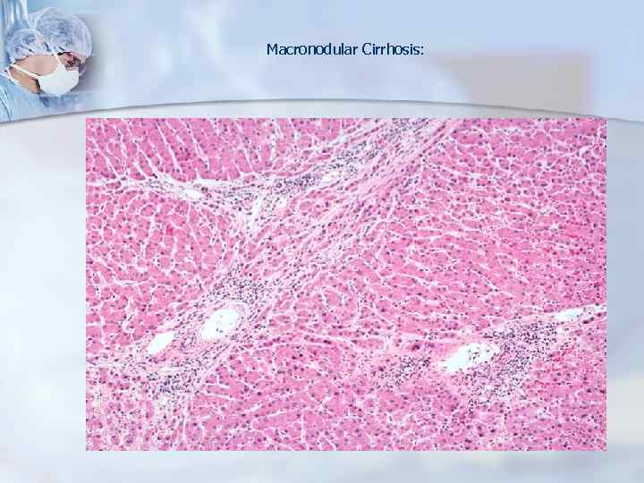 Macronodular Cirrhosis: 
