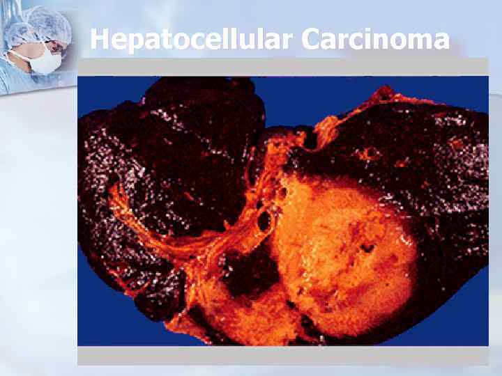 Hepatocellular Carcinoma 