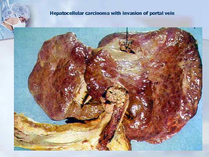 Hepatocellular carcinoma with invasion of portal vein 