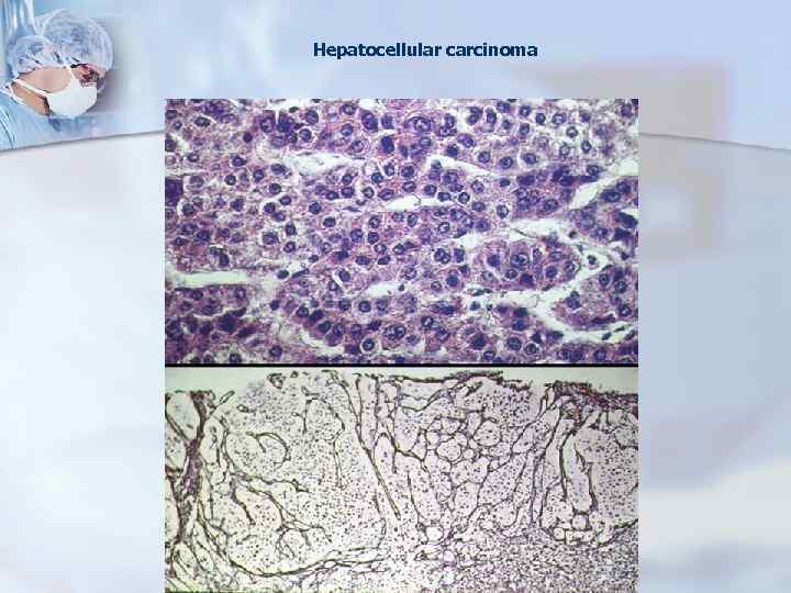 Hepatocellular carcinoma 