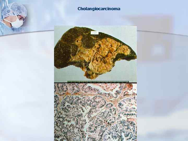 Cholangiocarcinoma 