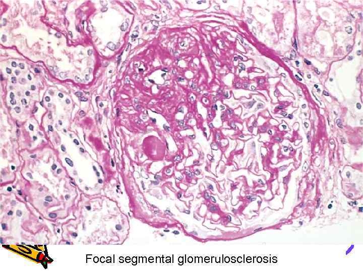 Focal segmental glomerulosclerosis 