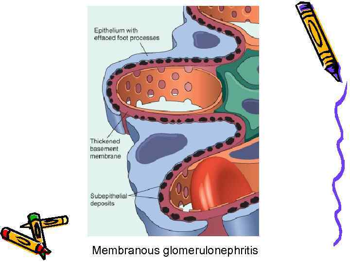 Membranous glomerulonephritis 