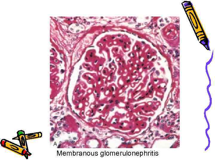 Membranous glomerulonephritis 