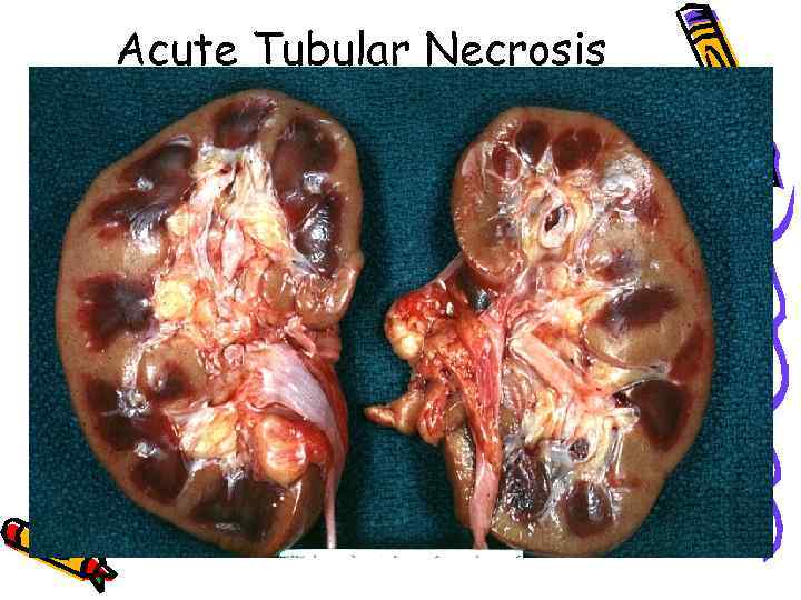 Acute Tubular Necrosis 