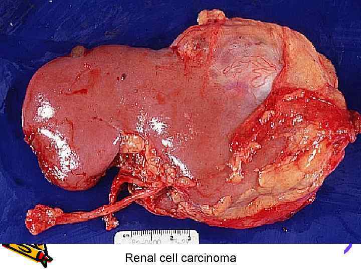 Renal cell carcinoma 