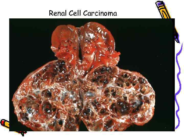 Renal Cell Carcinoma 