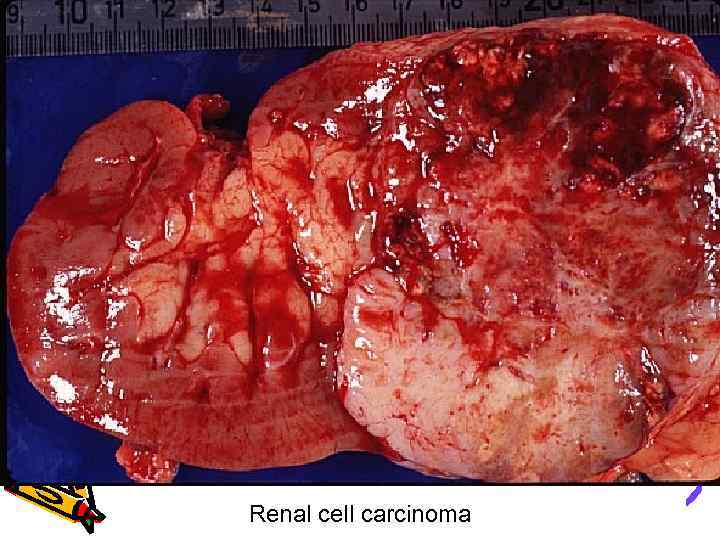 Renal cell carcinoma 