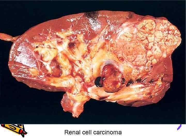 Renal cell carcinoma 