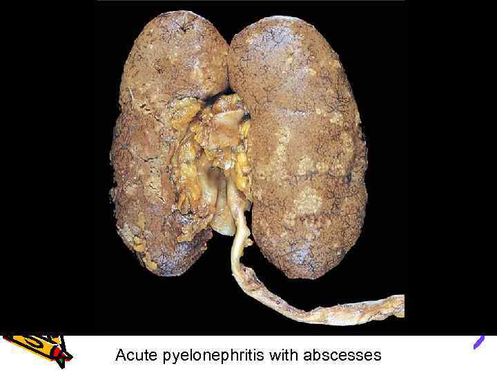 Acute pyelonephritis with abscesses 