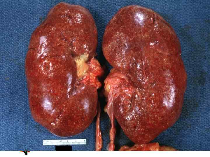 Acute Pyelonephritis 