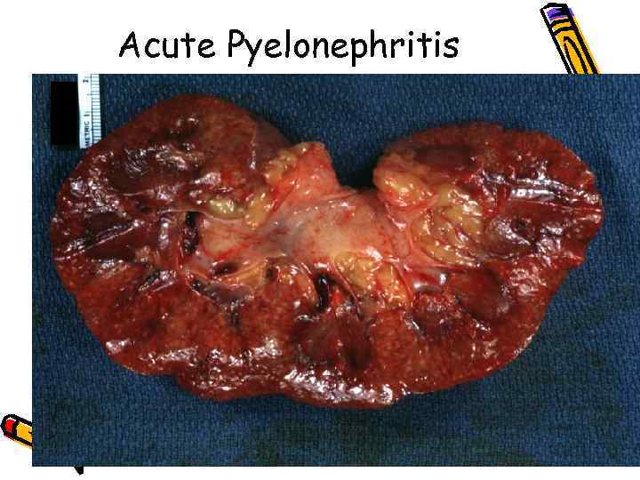 Acute Pyelonephritis 