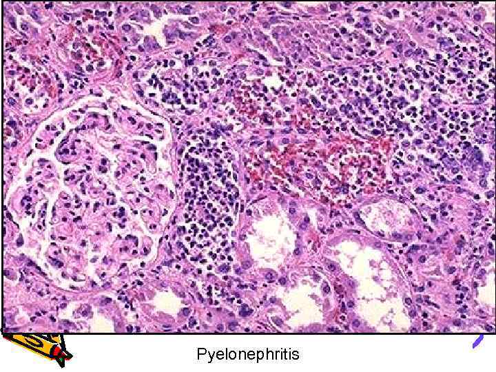 Pyelonephritis 