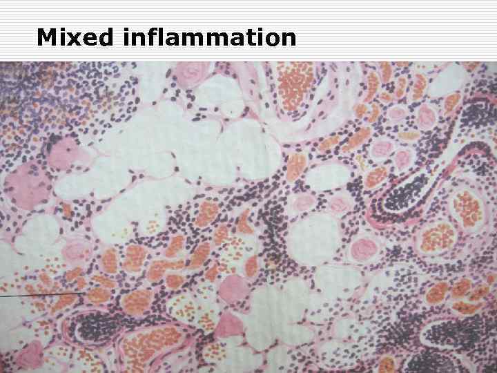 Mixed inflammation 