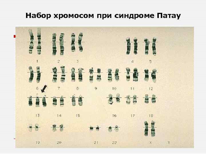 Набор хромосом при синдроме Патау 