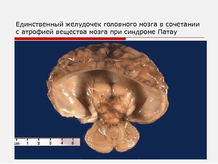 Единственный желудочек головного мозга в сочетании с атрофией вещества мозга при синдроме Патау 