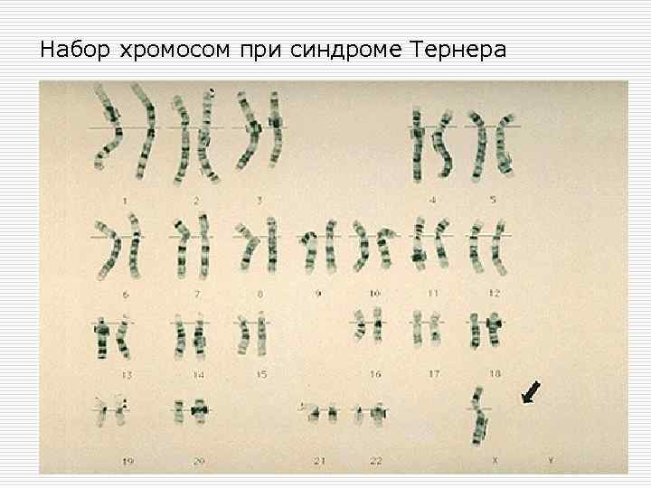 Набор хромосом при синдроме Тернера 