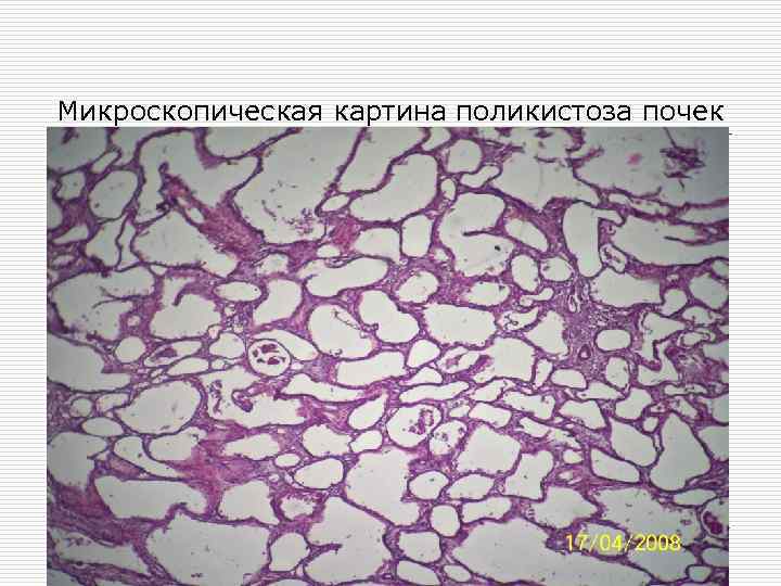 Микроскопическая картина поликистоза почек 