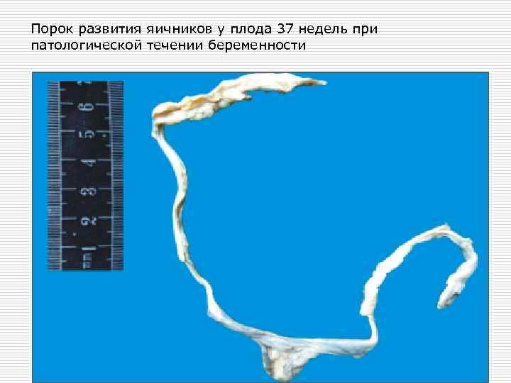 Порок развития яичников у плода 37 недель при патологической течении беременности 