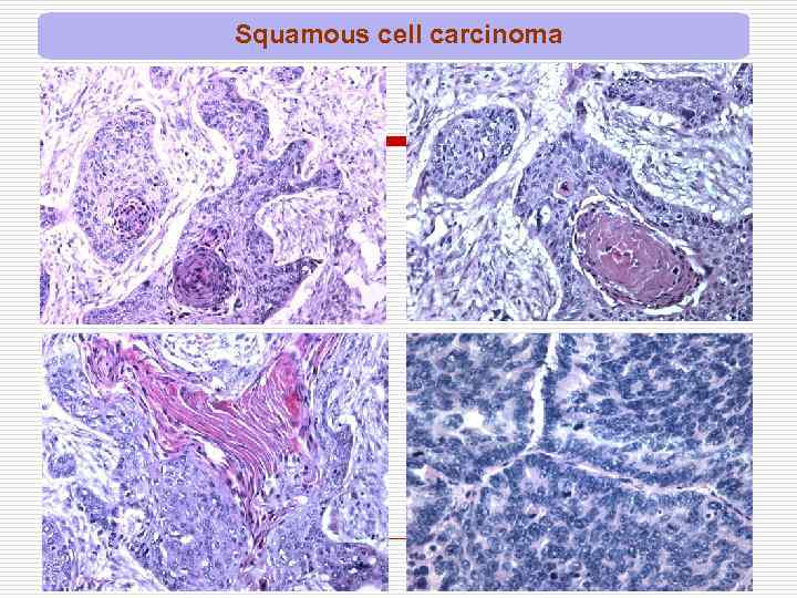 Squamous cell carcinoma 