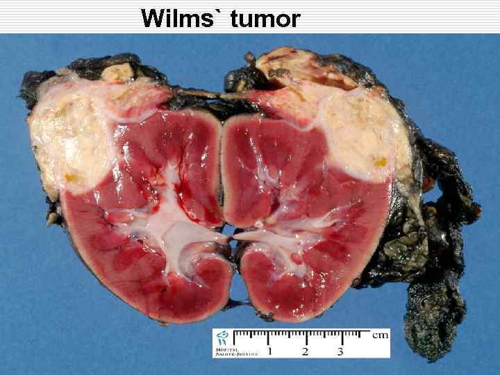 Wilms` tumor 
