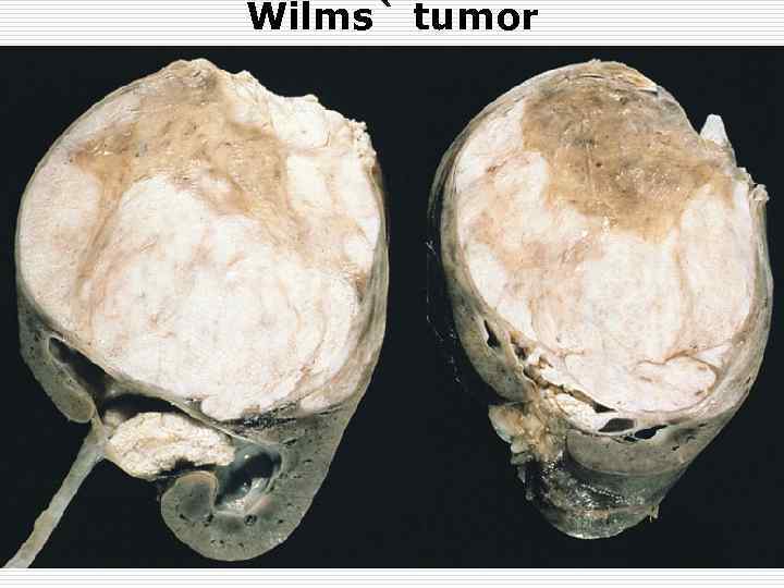 Wilms` tumor 