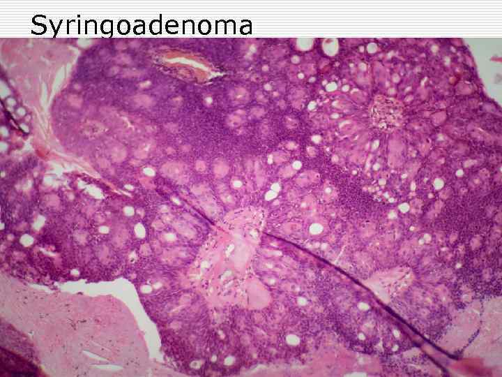 Syringoadenoma 