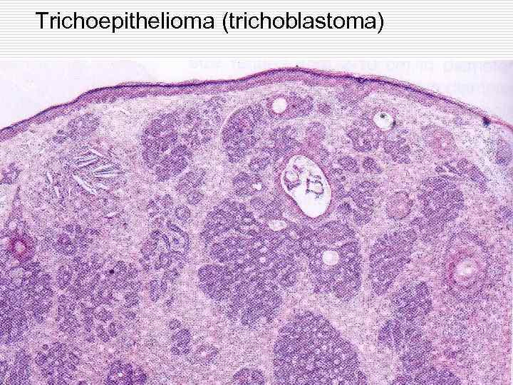 Trichoepithelioma (trichoblastoma) 