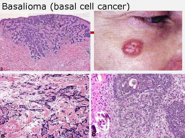 Basalioma (basal cell cancer) 