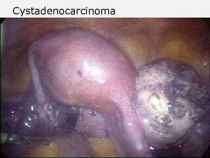 Cystadenocarcinoma 